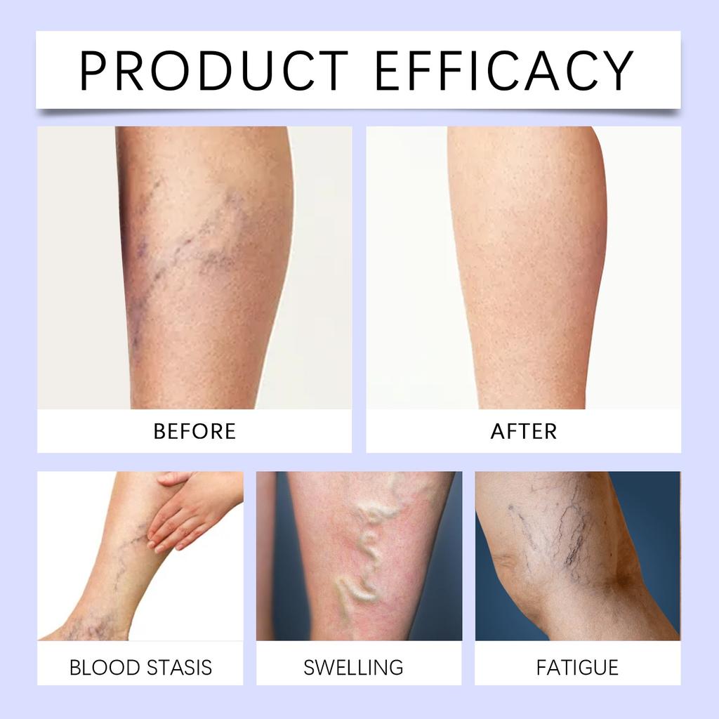 Varicose Veins Cream, Varicose Veins And Spider Veins Leg, Improve Blood Circulation, Fast-acting Relief Cream