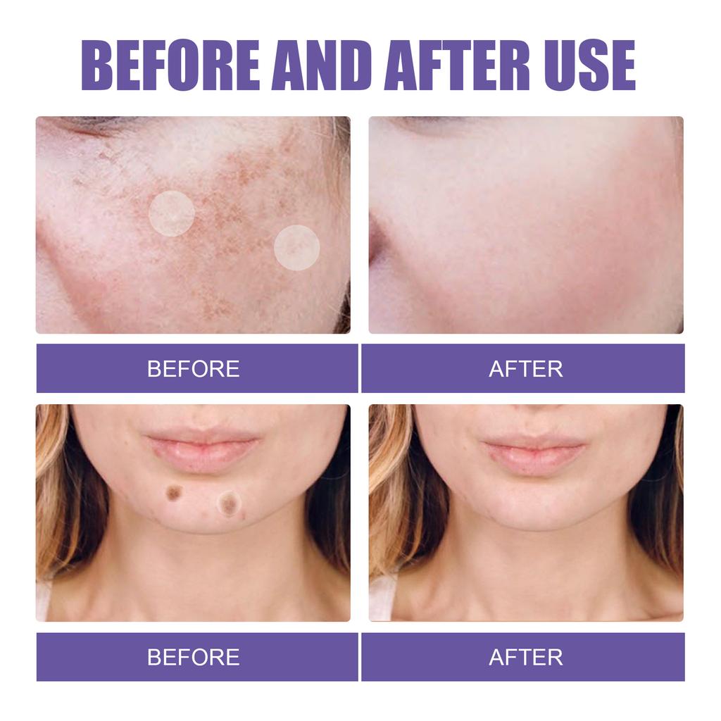 Пластырь EELHOE Blemish Patch осветляет темные пятна на лице, хлоазму, пигментацию, очищение, увлажнение, отбеливание кожи, Пластырь для устранения пятен