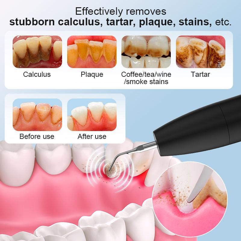 Интеллектуальный ультразвуковой очиститель зубов Стоматологический скалер 3 режима очистки Быстрая зарядка Частота 2 миллиона Удаление зубного камня Уход за деснами