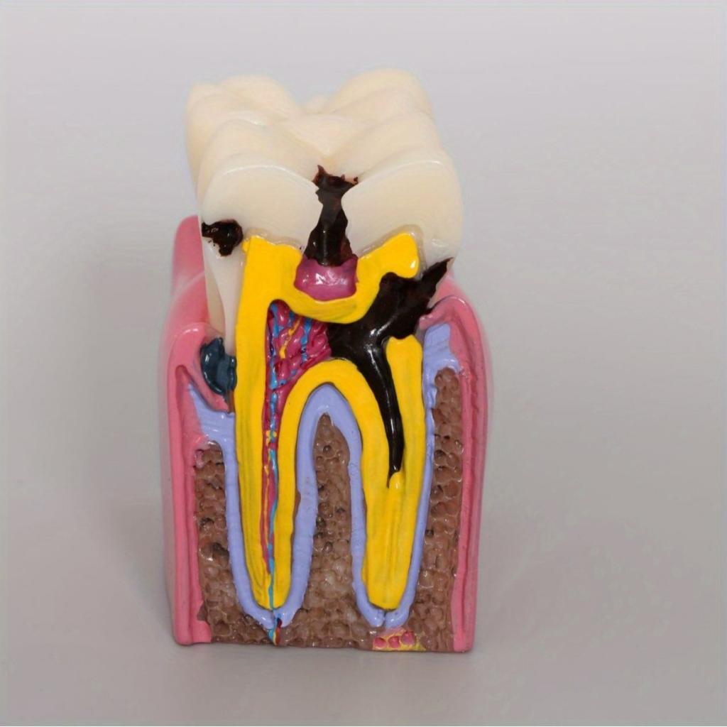 6 раз Модель кариеса зубов Болезнь зубов Стоматологическая модель для демонстрации зубов Модель обучения стоматолога Стоматологическая лаборатория Исследования полости рта