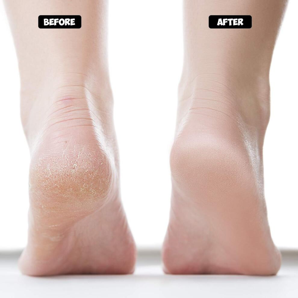 Crack Heel Repair Socks, Moisturizing Open Toe Socks For Dry Feet, Easy To Use During Rest Or Sleep, Flexible Cotton Blend Ensures Comfort And Fit,