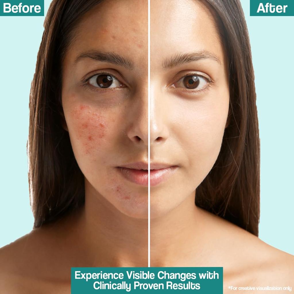 Dr. Reddy's Venusia Acne Control Moisturizer 75gm | Pore Minimizing Hydrating Moisturizer for Oily Skin