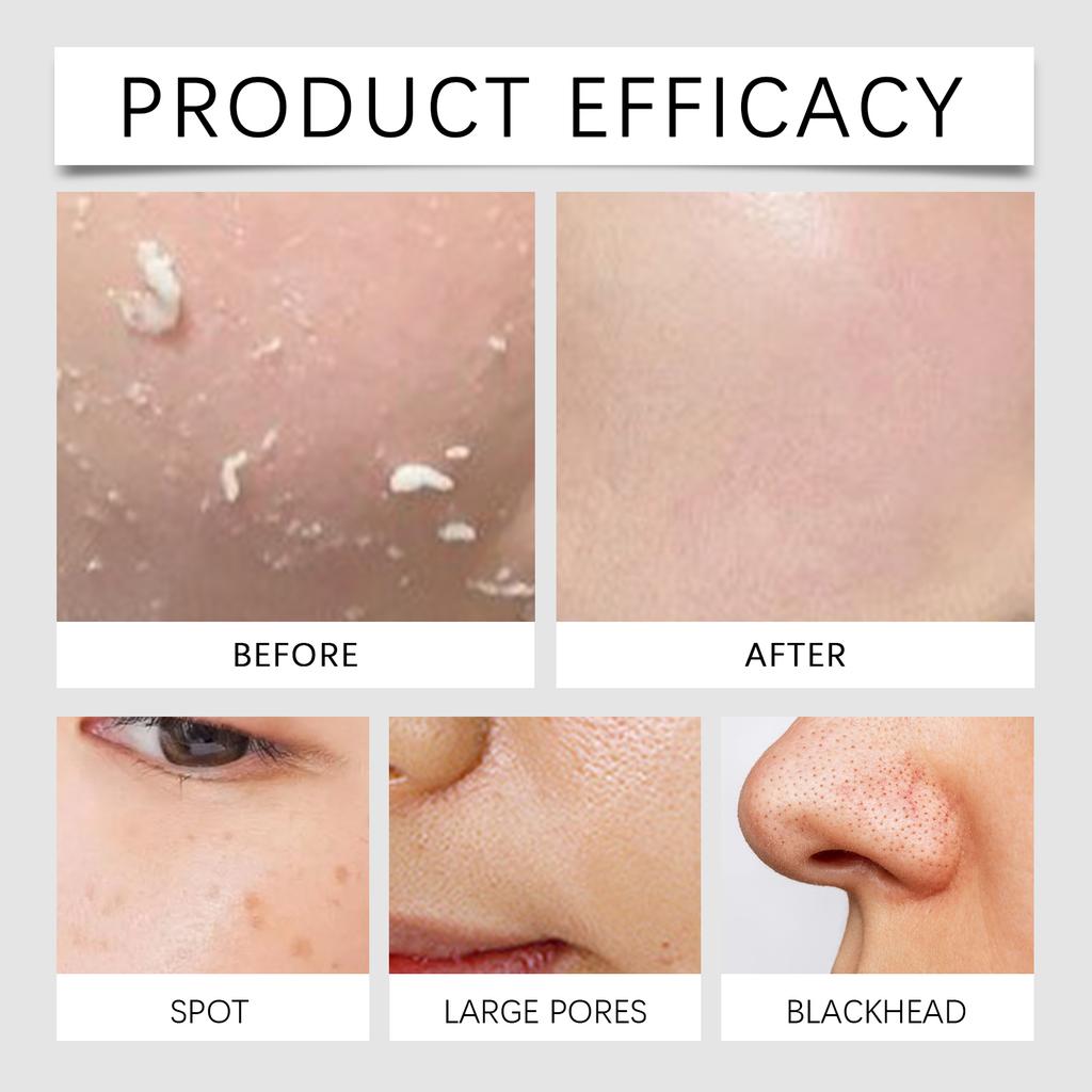 Отшелушивающий тоник с салициловой кислотой 100 мл Минимизатор пор Контроль над несовершенствами Жидкость Экстракт папайи Увлажняющее средство для лица для кожи, склонной к акне