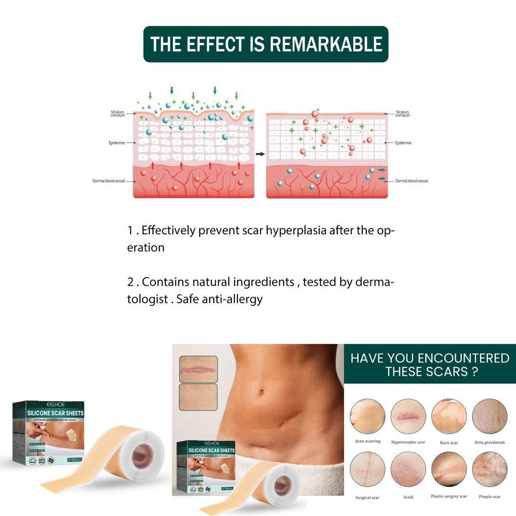 Eelhoe Silicone Scar Patch For Stretch Marks And Burn Scars Suitable For All Skin Types