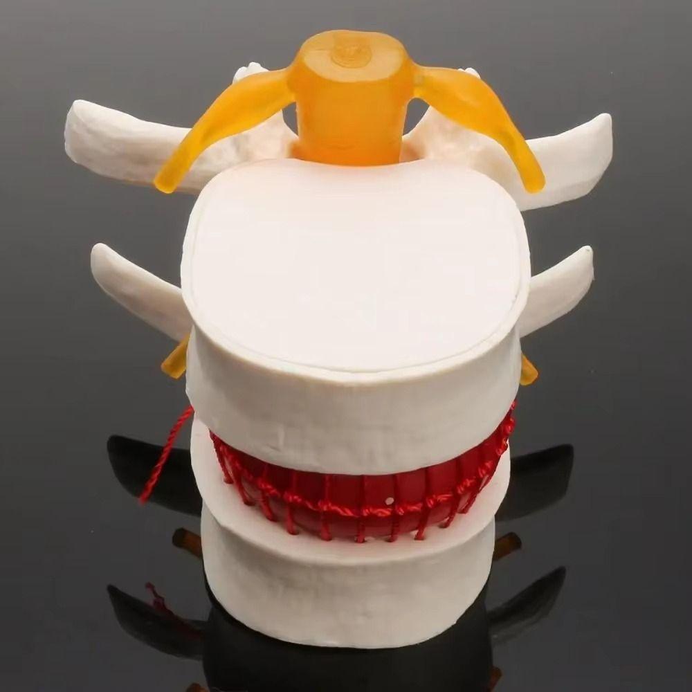 3D Model Human Anatomy Skeleton Model Lumbar Disc Herniation Teaching Tool Nursing