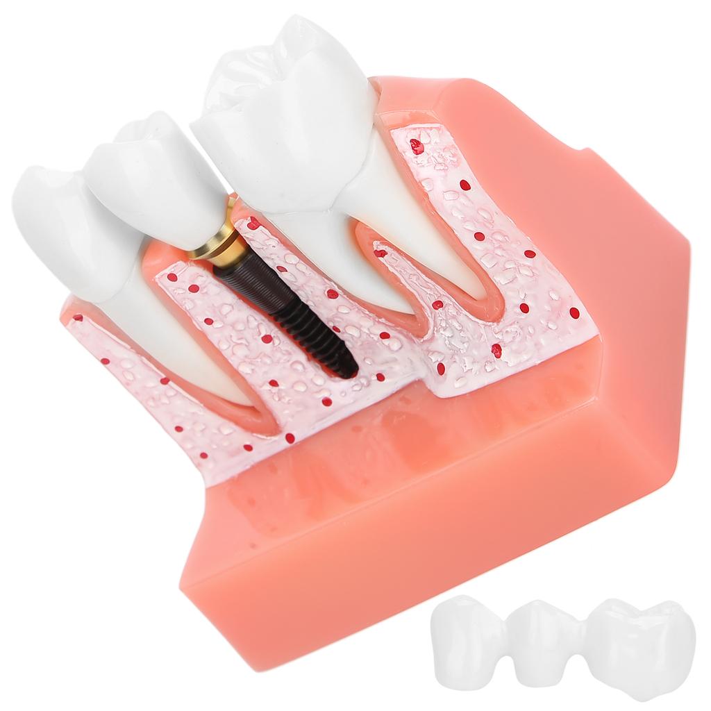 Модель зубов Анализ зубного имплантата Модель короночного моста Демонстрационная модель зуба