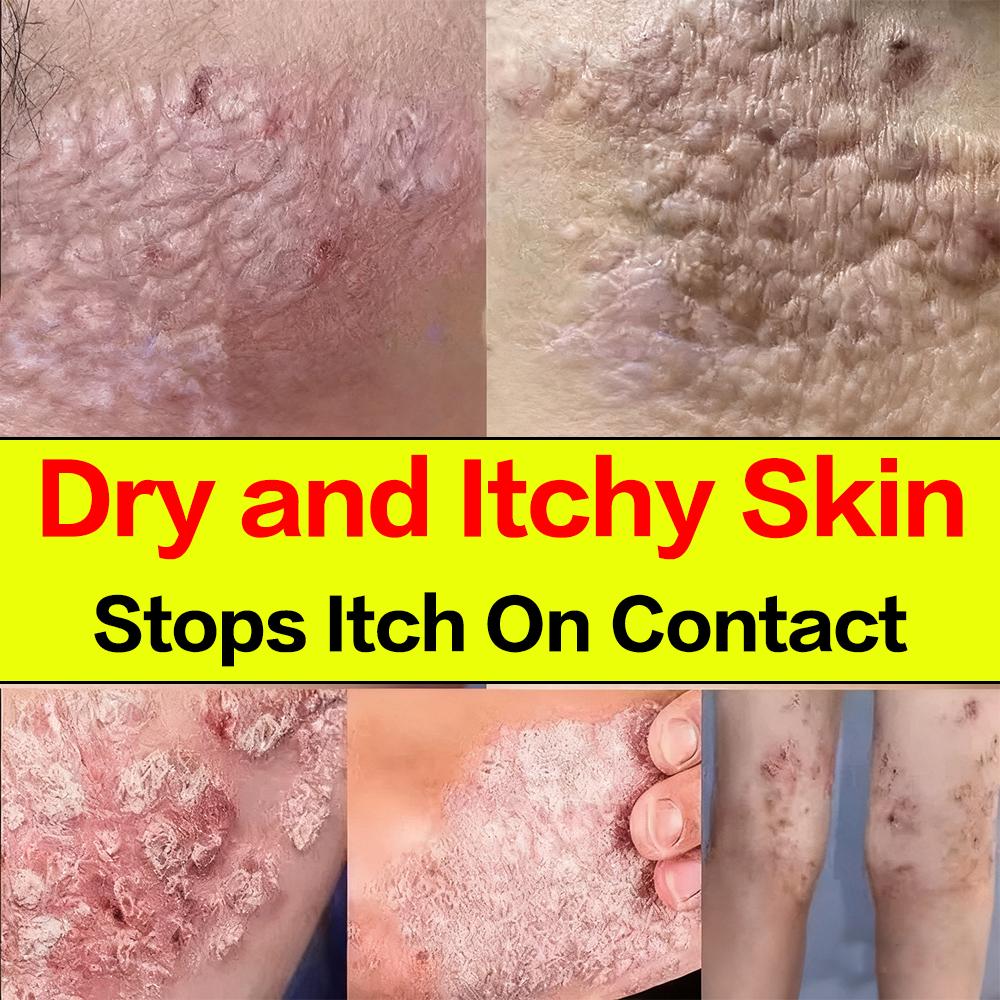 Лечебный крем, предназначенный для ухода за экземой