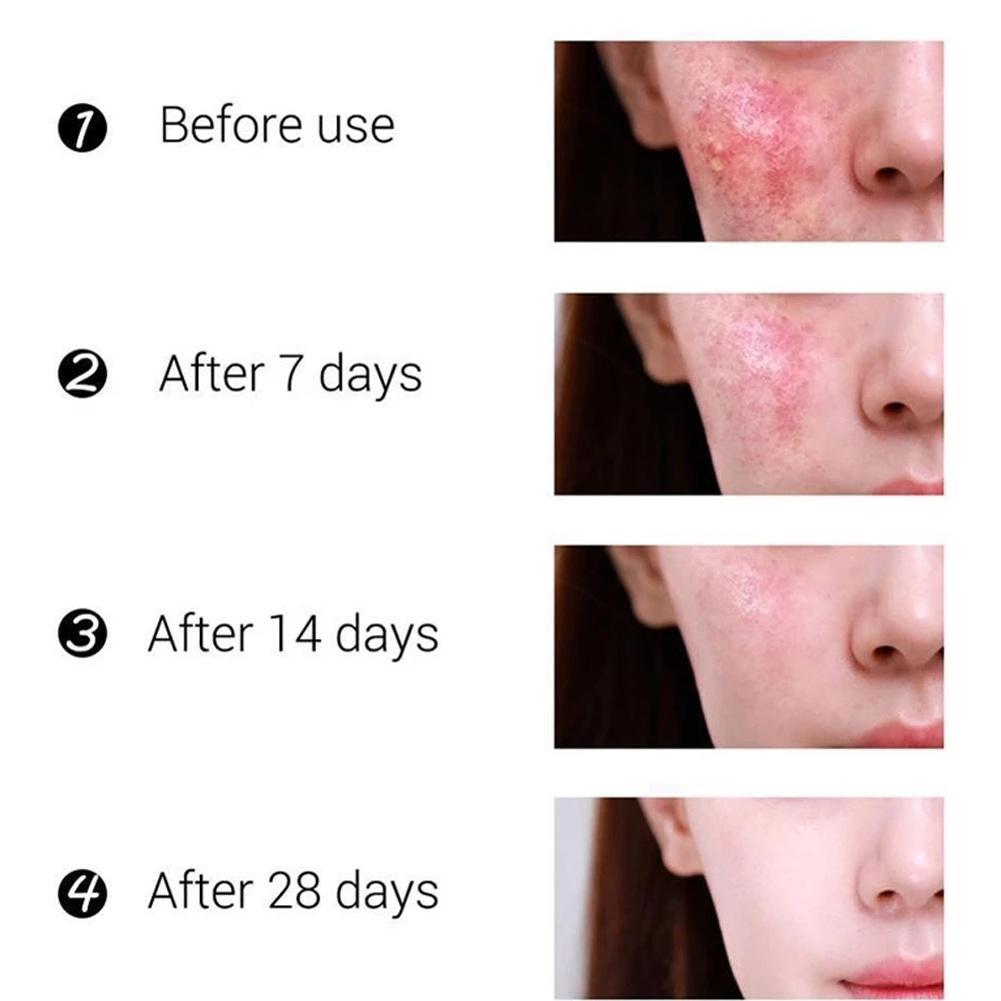 Отбеливающий крем от веснушек, крем для удаления мелазмы, средство для удаления пятен, осветляющее мелазму, темные пятна, анти-Ag Z8A7