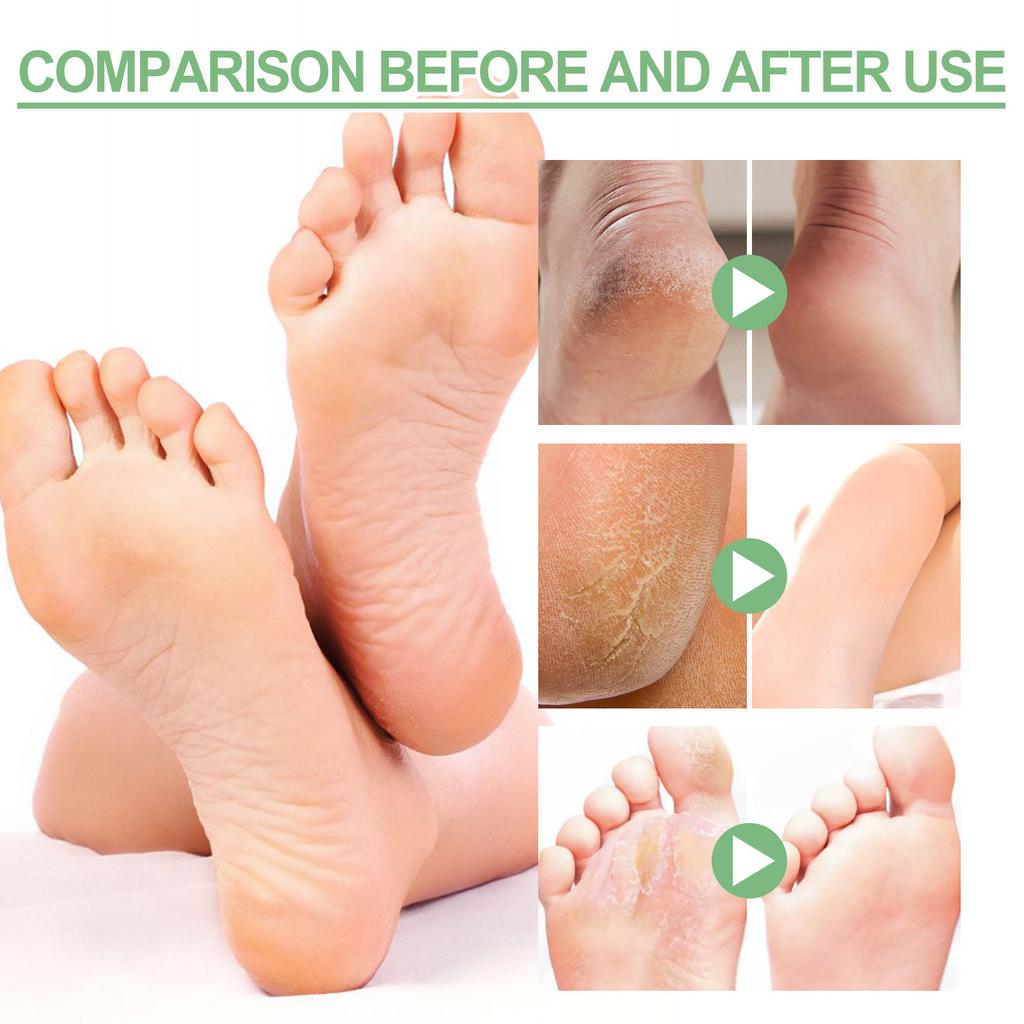 Крем для ног Heel Rescue, для потрескавшейся, мозолистой или потрескавшейся кожи. Отшелушивание пяток для предотвращения сухости, трещин и мозолей на ногах.