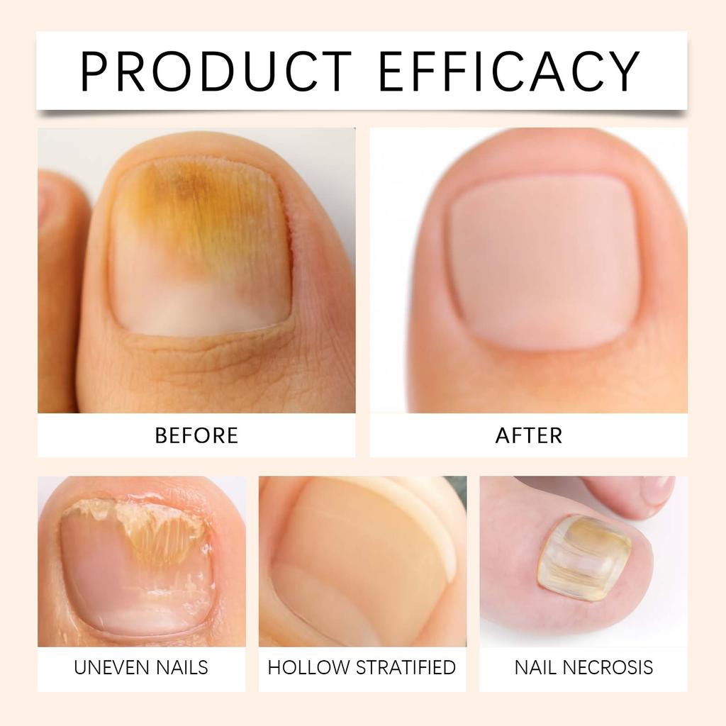 Спрей для ухода за ногтями Спрей для ногтей Успокаивающий спрей для ногтей Укрепляет ногти для уменьшения ломкости, 20 мл