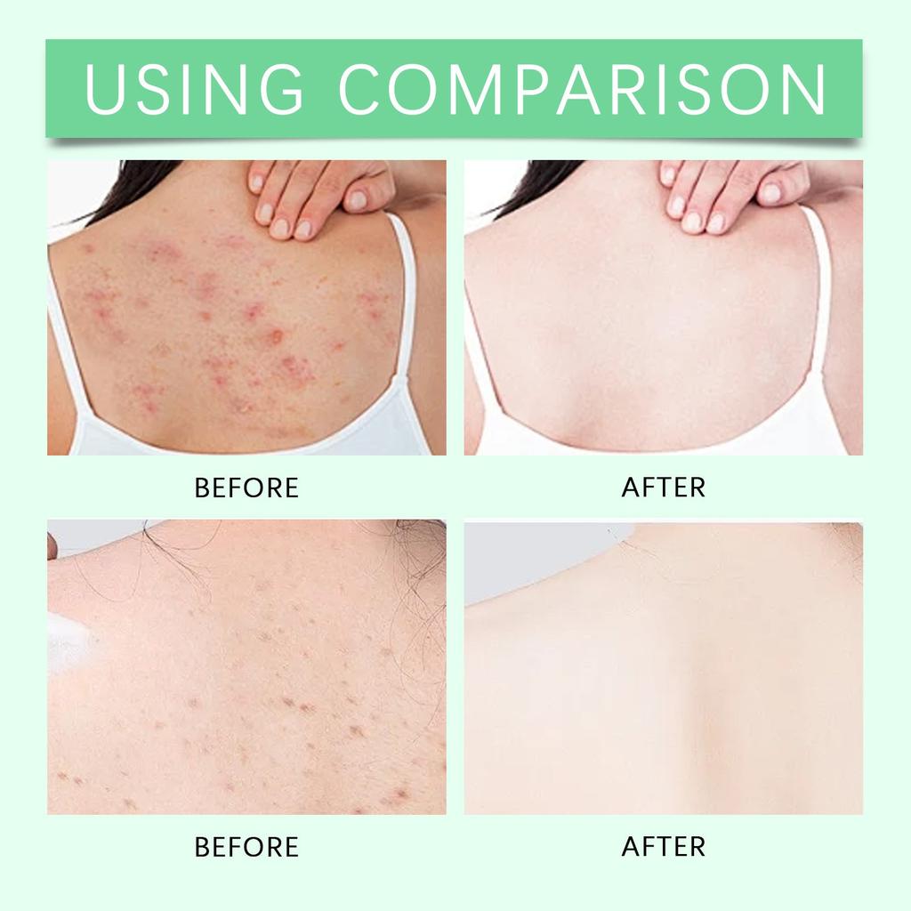 Спрей для ухода за кожей спины Разглаживающий, Осветляющий, Сужающий поры и Мягкий спрей для ухода за кожей, склонной к акне 100 мл