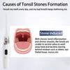 Electric Tonsil Stone Remover Tonsil Stone Removal Kit Vacuum With Irrigation Syringe Instant Suction Tonsil Stone Removal