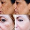 Whitening Freckle Cream Effective Remove Dark Spots Anti Freckle Cream Fade Pigmentation Melasma Brighten Cream