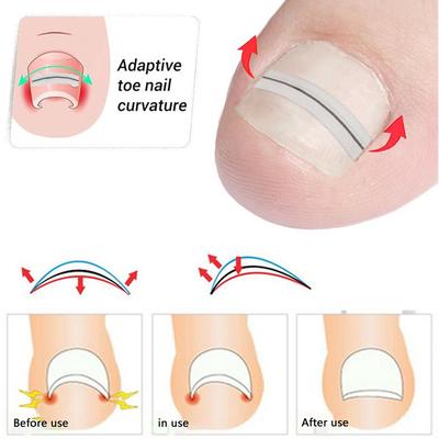 Инструмент для коррекции вросшего ногтя на ноге Выпрямляющая клипса Скоба Лечение вросшего ногтя Эластичная наклейка-пластырь Инструмент для педикюра