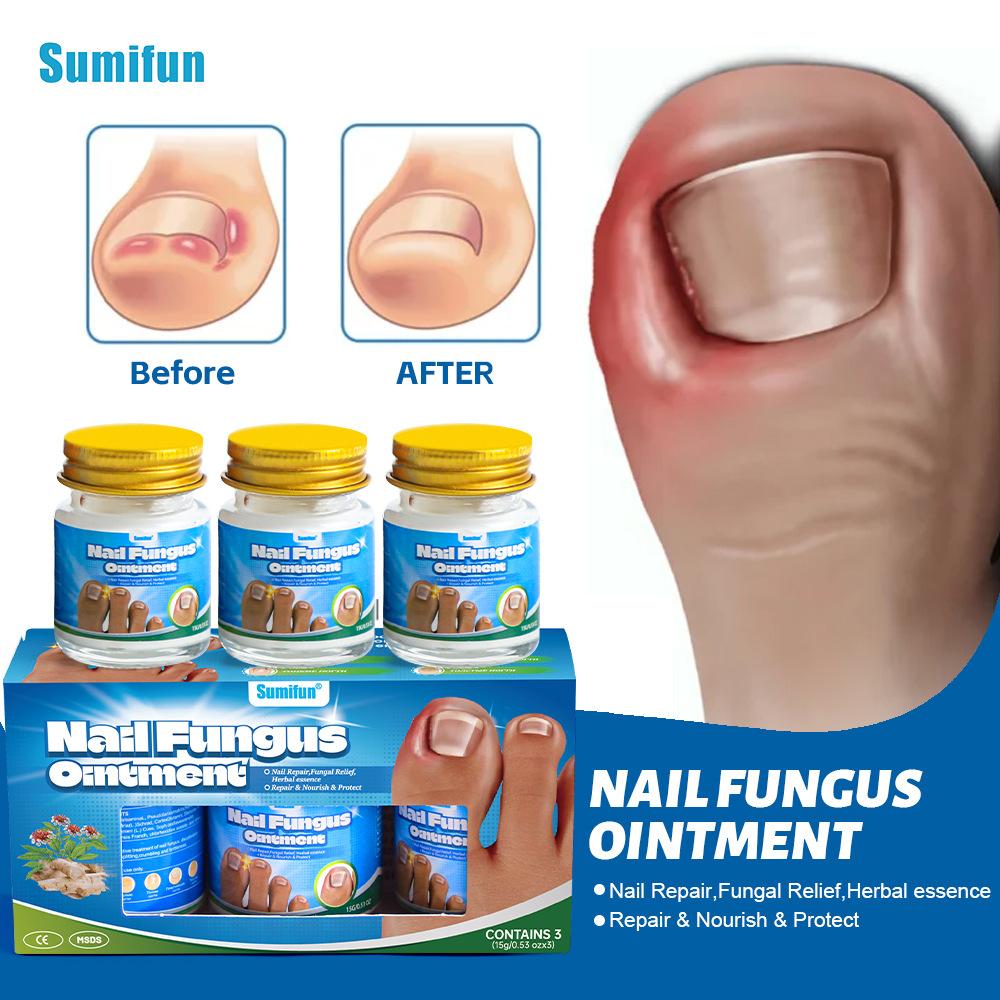 Sumifun 1 Pc Onychomycosis Nail Repair Cream Solution Remove Toenail Fungus Paronychia Nourish Moisturize Nails for Thick,Discolored,Cloud