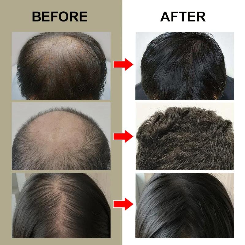 PURC Масло для быстрого роста волос, против выпадения волос, лечебная сыворотка с эфирным маслом имбиря, средства по уходу за волосами