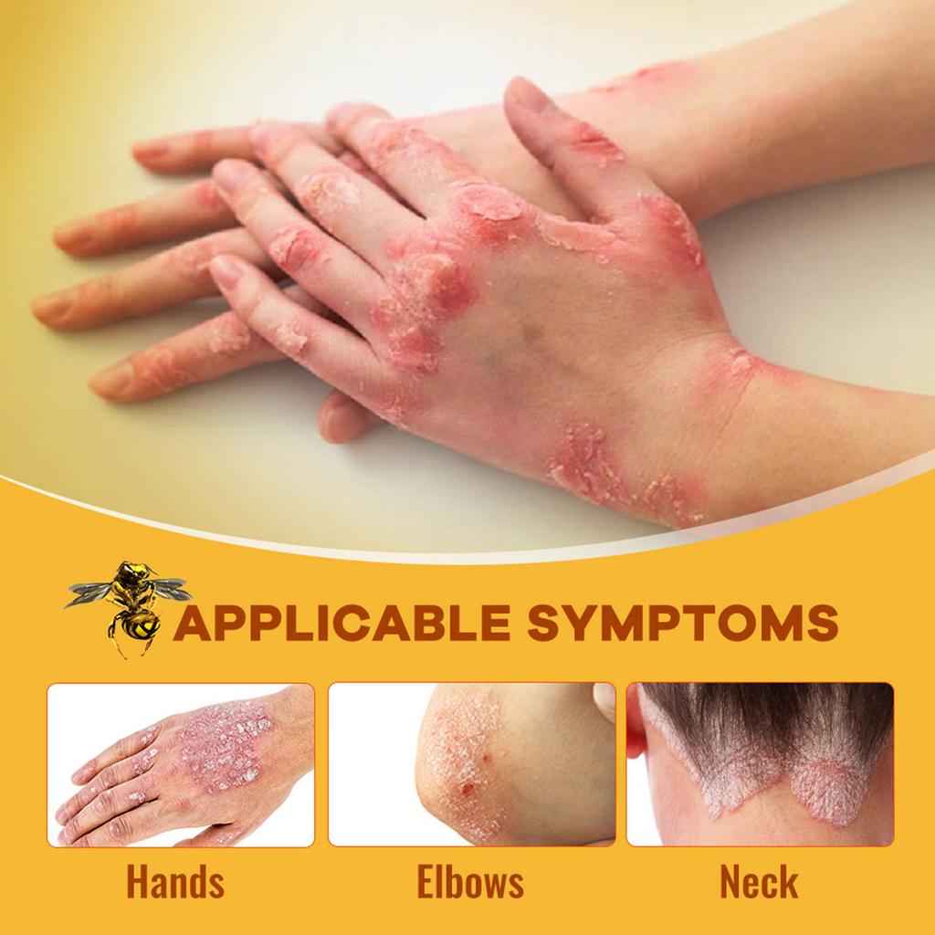 Пластырь Bee Series Крем от стригущего лишая на коровьей коже Крем для кожи Зудящий крем