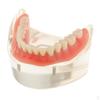 Oral Teeth Study Teach Demonstration Model Overdenture Inferior 2 Implant Demo Teaching -