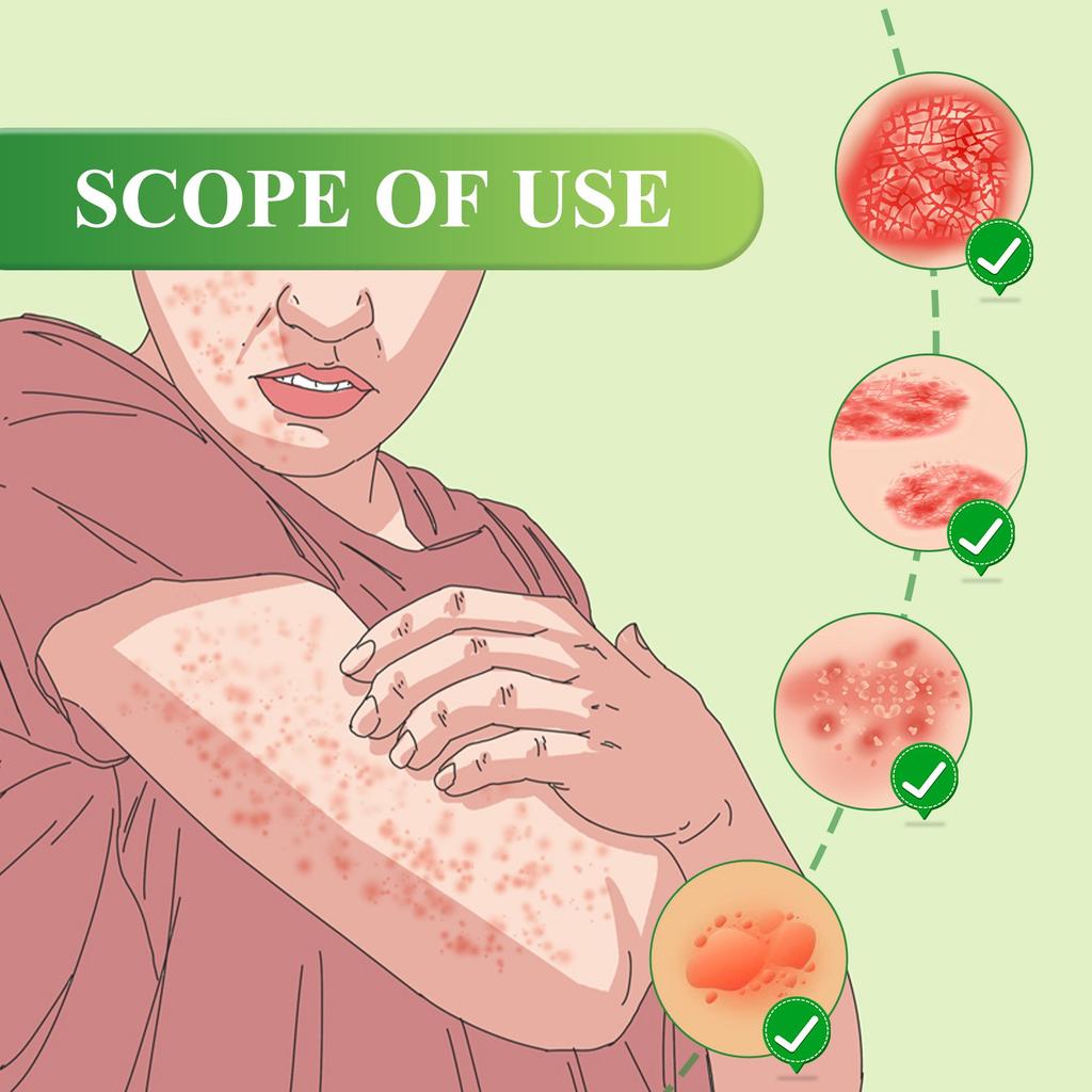 Moisturizing Skin Anainst Itch Cream,Remove Itching, Sweat Blisters, Skin Swelling,