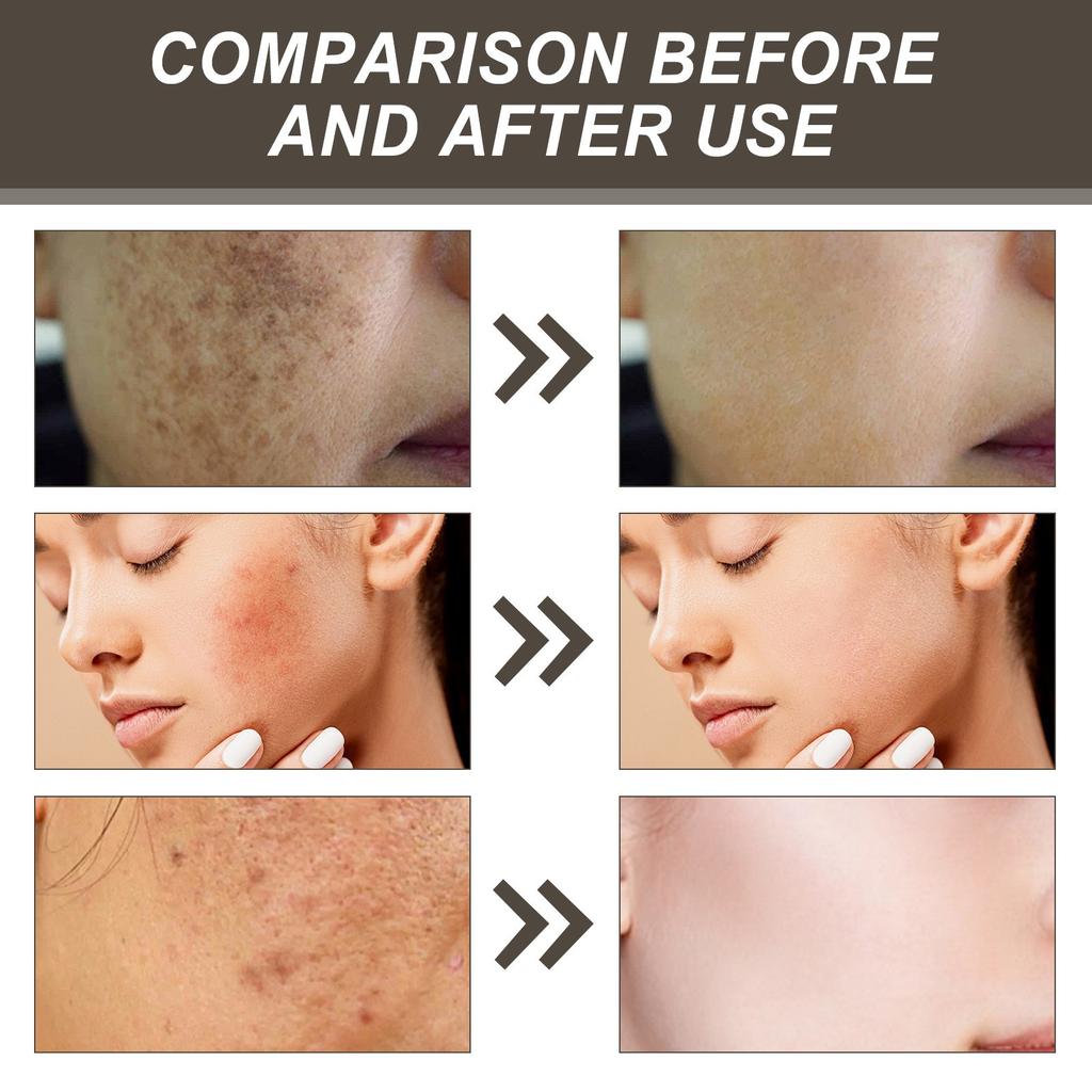 Патчи для лица от прыщей, микроиглы, сушильные патчи, закрывающие наклейки, 72 шт., уход, впитываются весь день