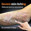Крем от зуда, экземы и дерматита - Мощное средство для снятия покраснений, сыпи, шелушения