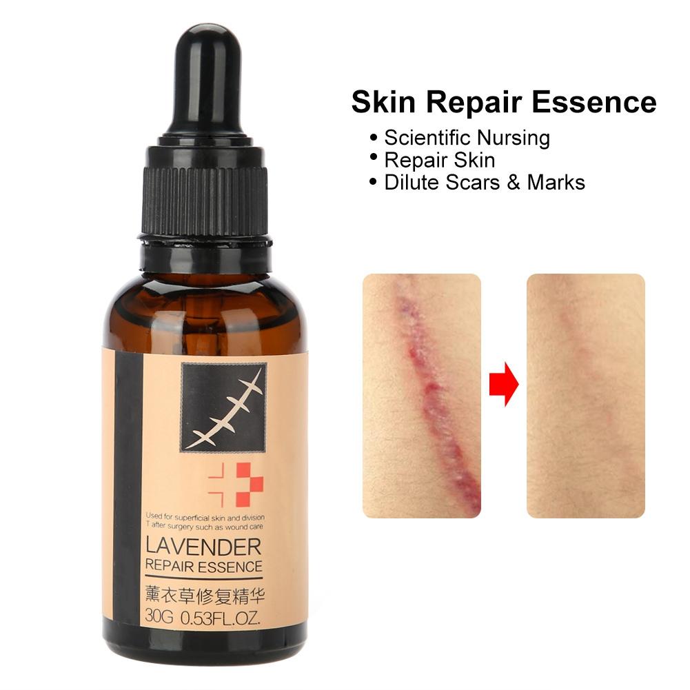 Эссенция для лечения угревой сыпи и рубцов Lavender Scar Acne Repair Essence Essence Stretch Marks Treatment Skin Repair Liquid