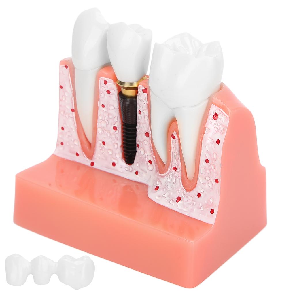 Модель зубов Анализ зубного имплантата Модель короночного моста Демонстрационная модель зуба