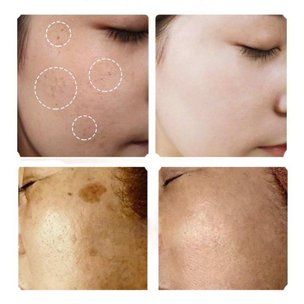 Крем для отбеливания пятен от загара Age Mushroom Vitamin E, 20 г, 2 шт.