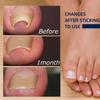 Toenail Correction Patch,  Ingrown Toenails Treatment Sticker - Toe Correction Sticker