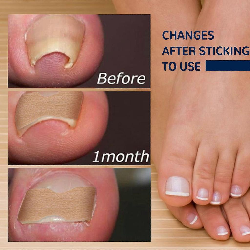 Toenail Correction Patch,  Ingrown Toenails Treatment Sticker - Toe Correction Sticker