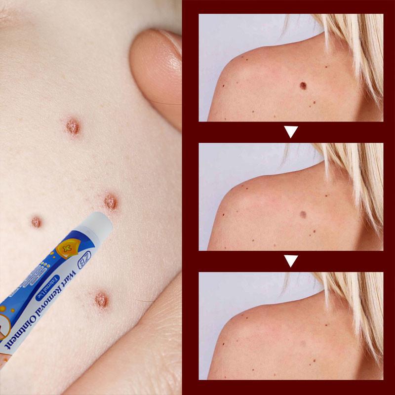 Крем для удаления мозолей и родинок