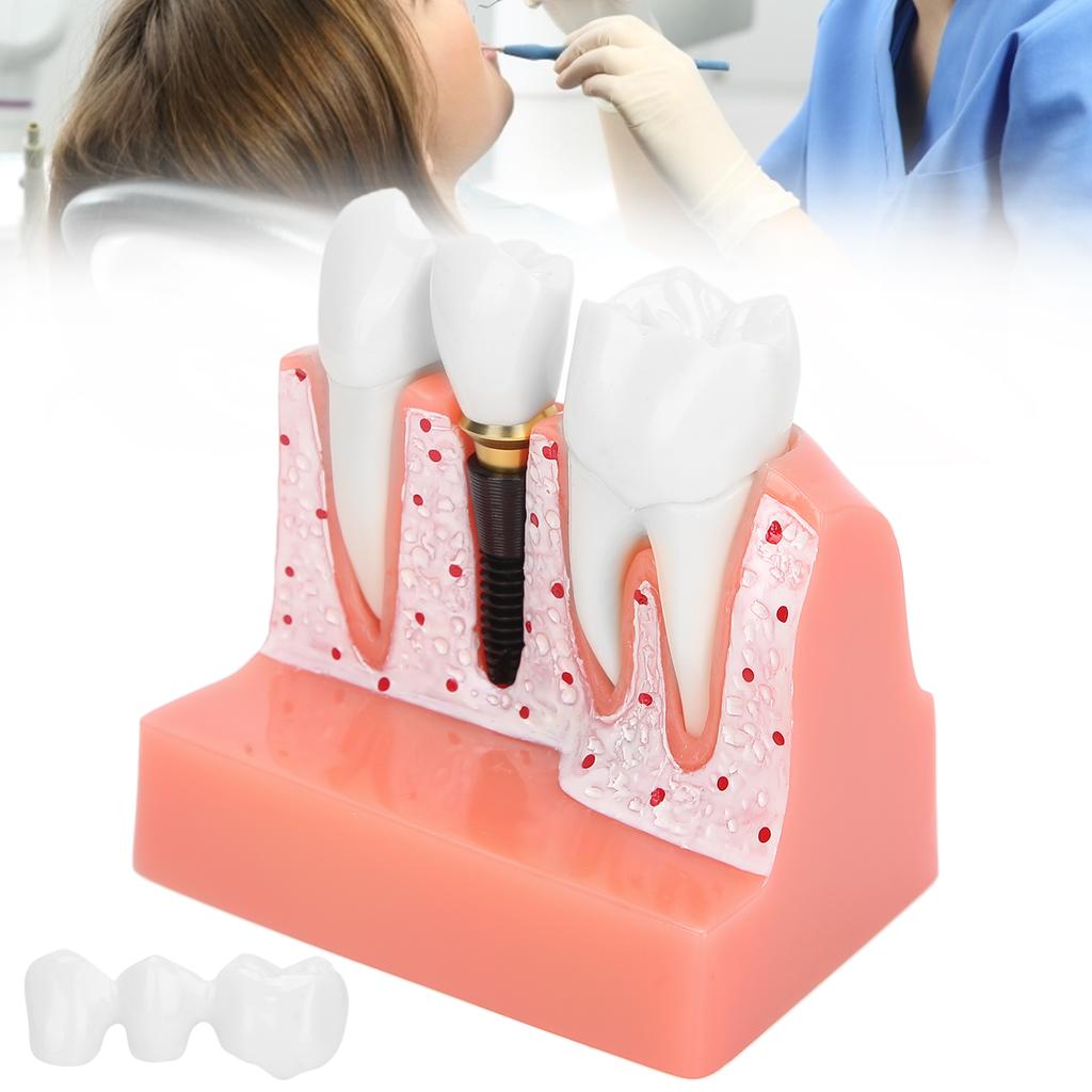 Модель зубов Анализ зубного имплантата Модель короночного моста Демонстрационная модель зуба