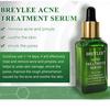 Сыворотка для лечения акне, эссенция для лица, против шрамов от прыщей, отбеливающий крем для ухода за кожей