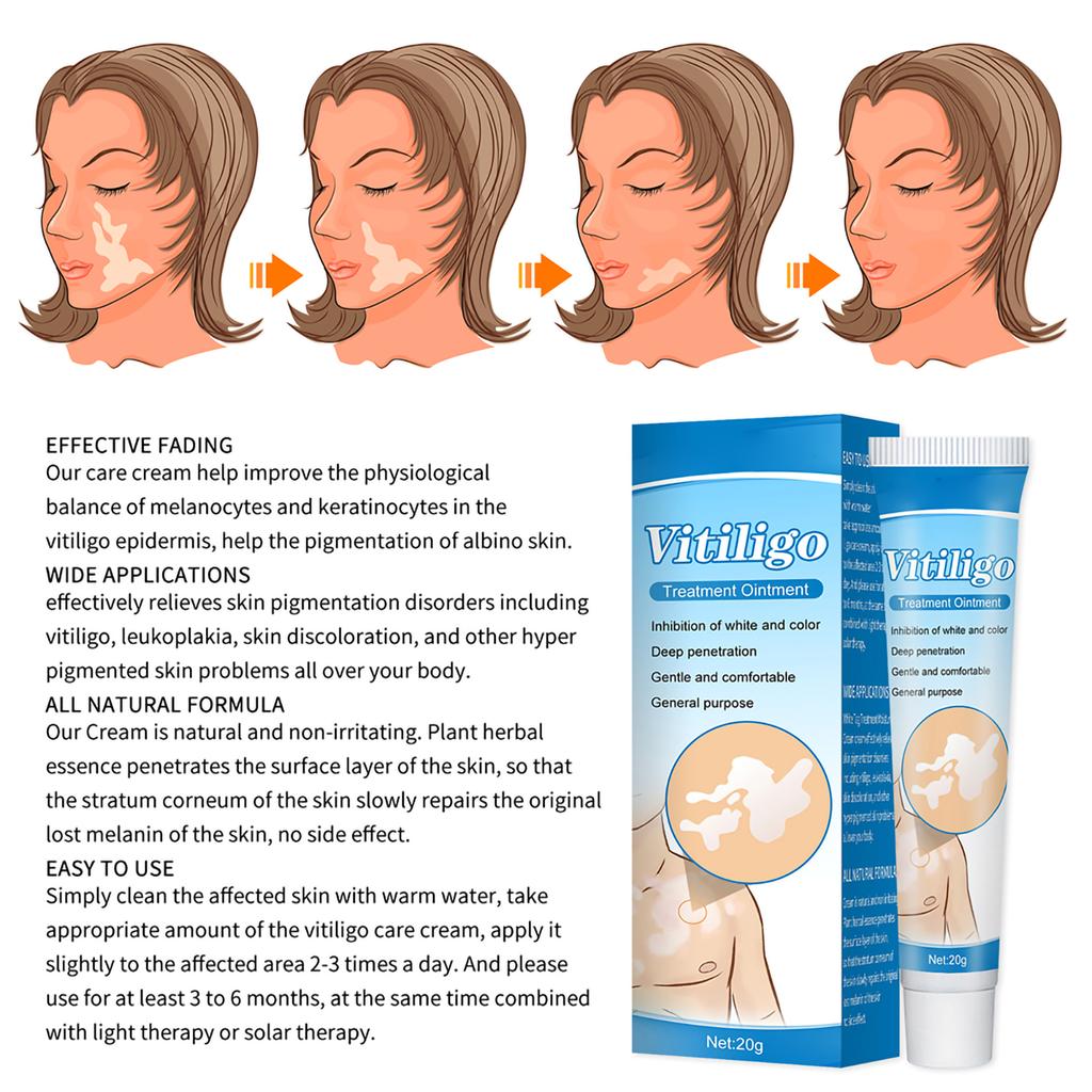 White Spot Piebald Cream Vitiligo Ointment Herbal Sweat Spot Cream Body Skin Care