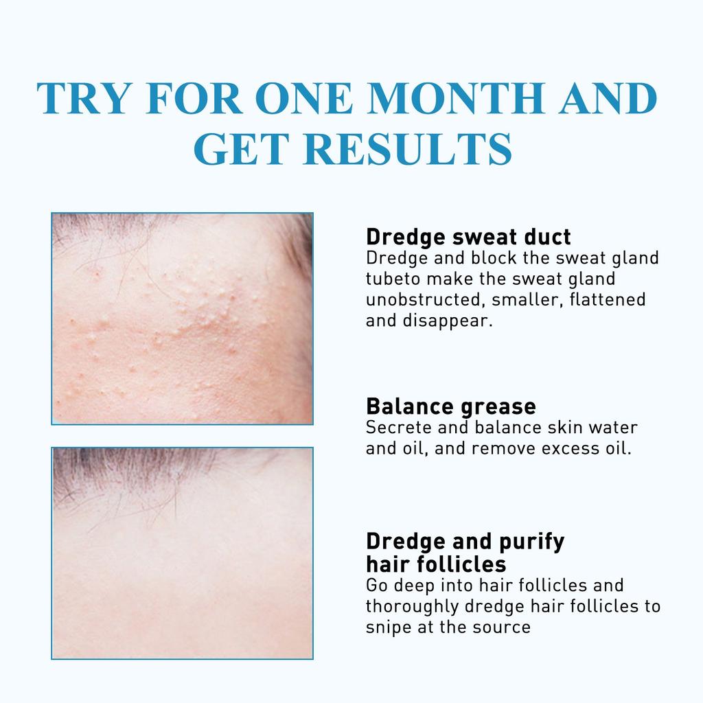 Пластырь с жировыми гранулами, удаление гранул масла с лица, подкожных комков, плоский пластырь для восстановления гранул потовой трубки