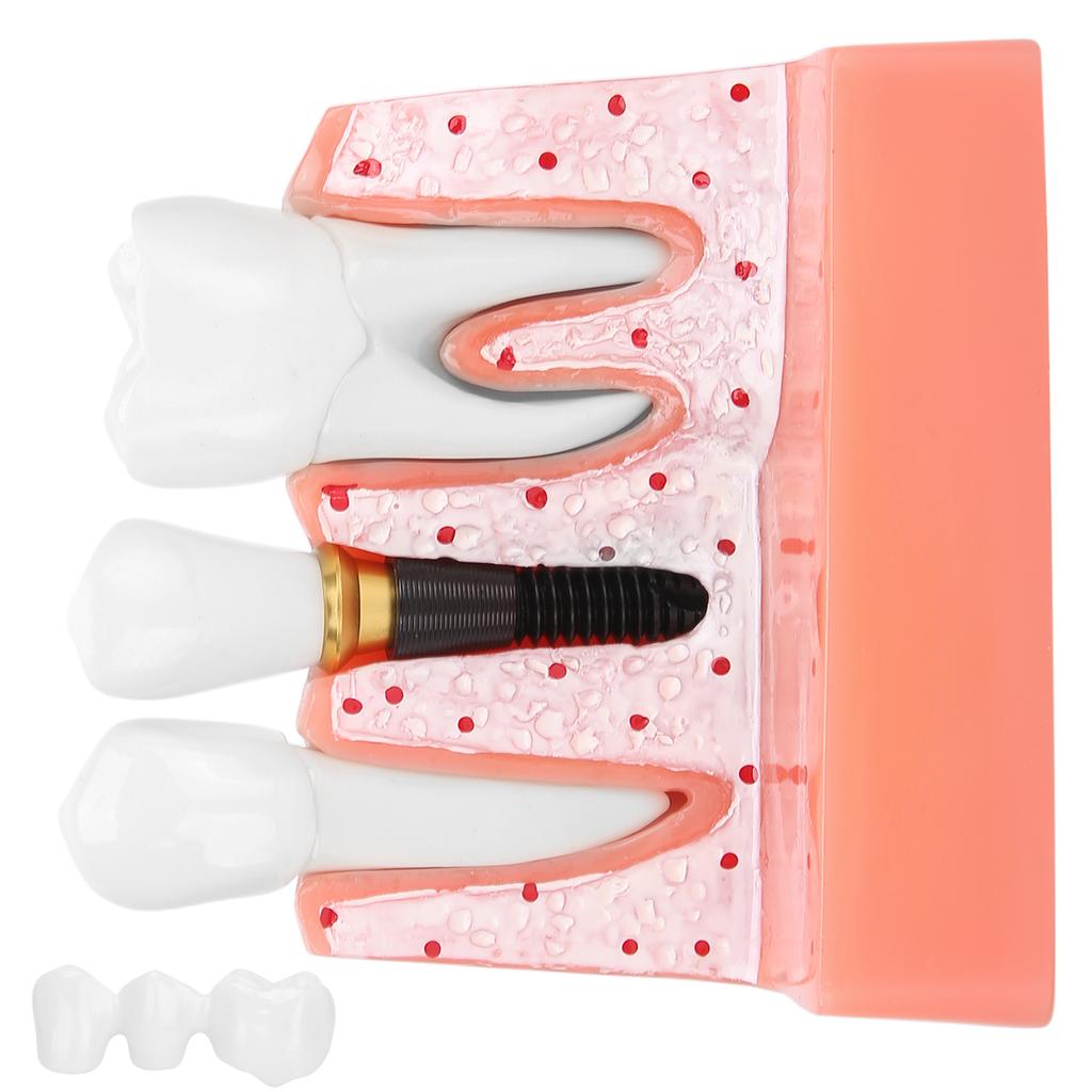 Модель зубов Анализ зубного имплантата Модель короночного моста Демонстрационная модель зуба