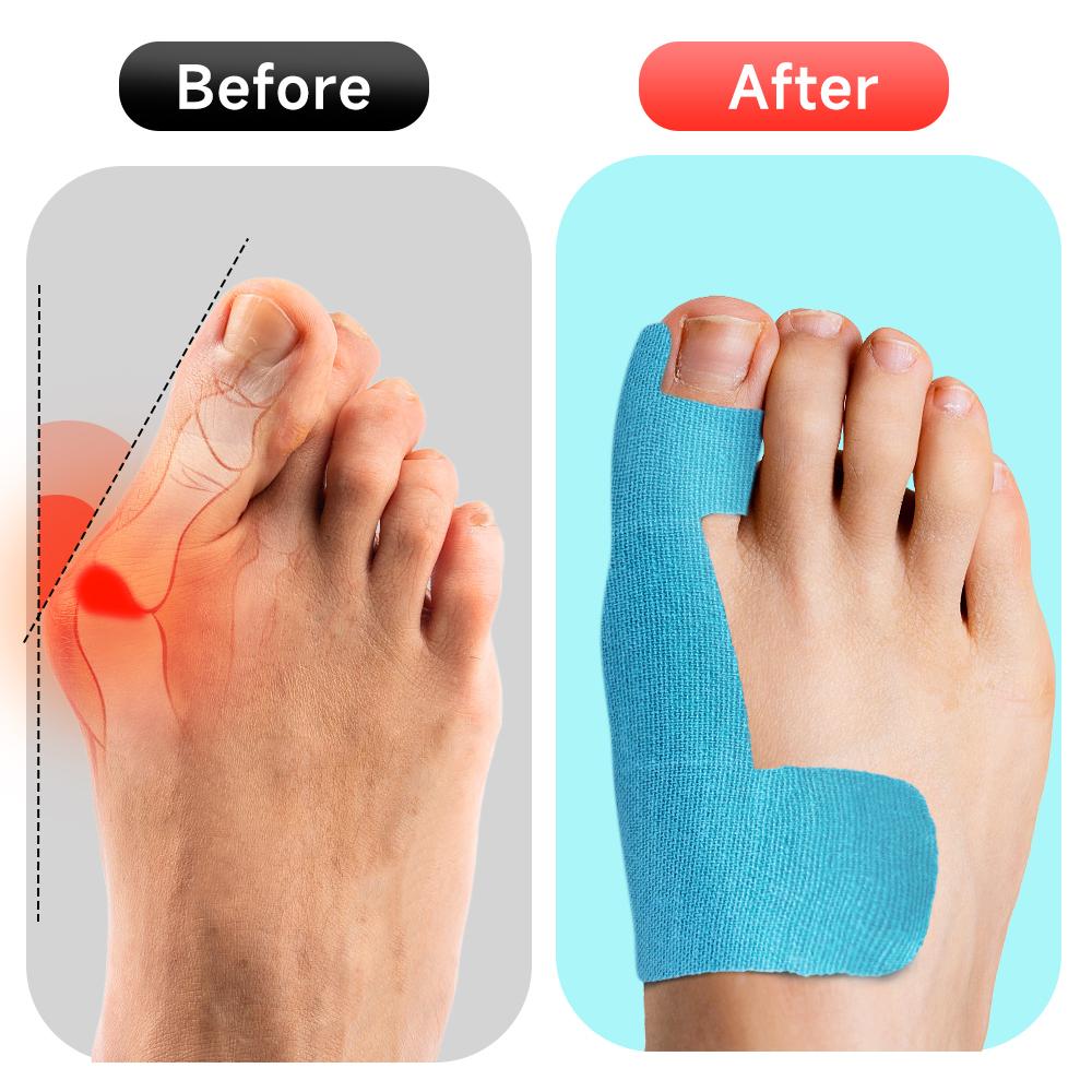 Корректирующая лента для косточки большого пальца стопы, ортез Hallux Valgus для облегчения боли в большом пальце ноги, коррекция, разделитель пальцев, спортивный защитный выпрямитель