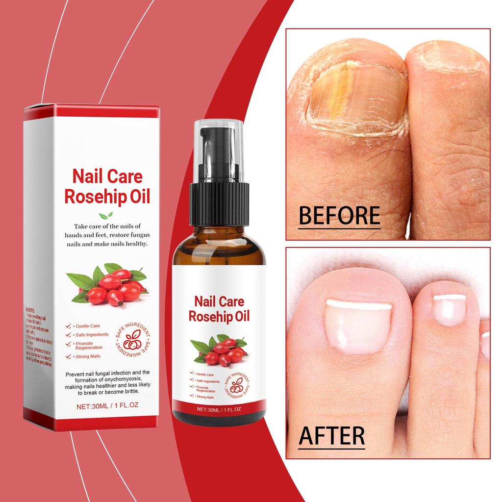 Rosehip Oil Nail Care Liquid Nourishing Moisturizing To Remove Onychomycosis Hand And Foot Nail Care Products Fungus Care 30ML