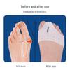 Разделитель пальцев при Hallux Valgus и Поддерживающая стелька с подушечкой для массажа передней части стопы - Корректор косточки для дневного и ночного использования