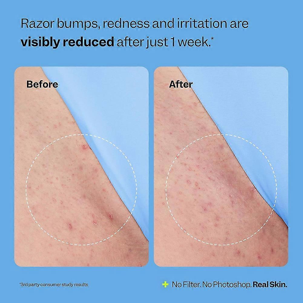 50ml Ingrown Hair Treatment Serum for Bikini Line Underarms and Legs Redness Relief with Natural Plant Extracts Non-Greasy Fast Absorbing Gentle