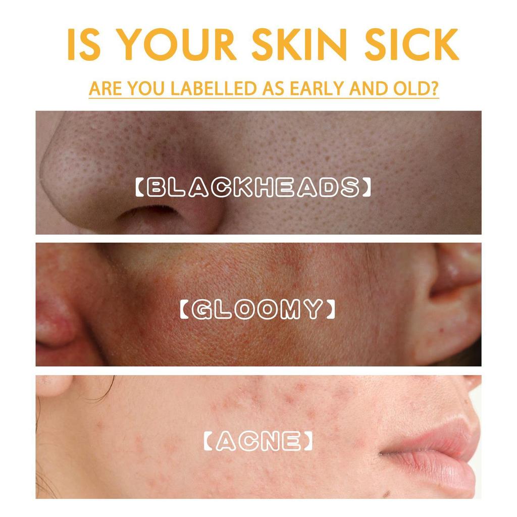 Осветляющая отшелушивающая маска, отбеливание и улучшение кожи, осветление пятен, меланин, удаление черных точек, против морщин, укрепление кожи