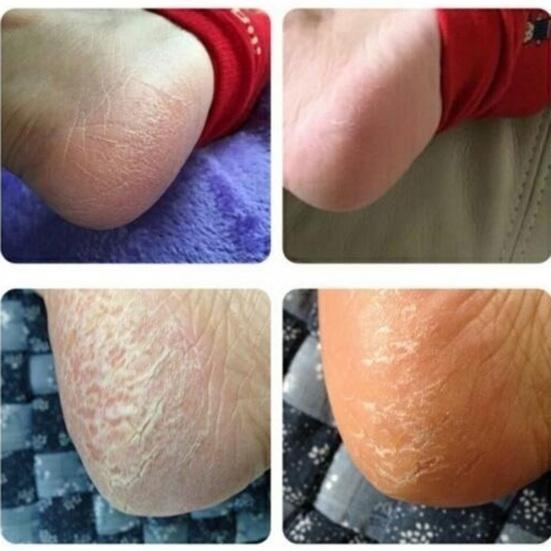 88g Anti Crack Moisturizing Hand Foot Cream Repairing Fissures Heal Ointment