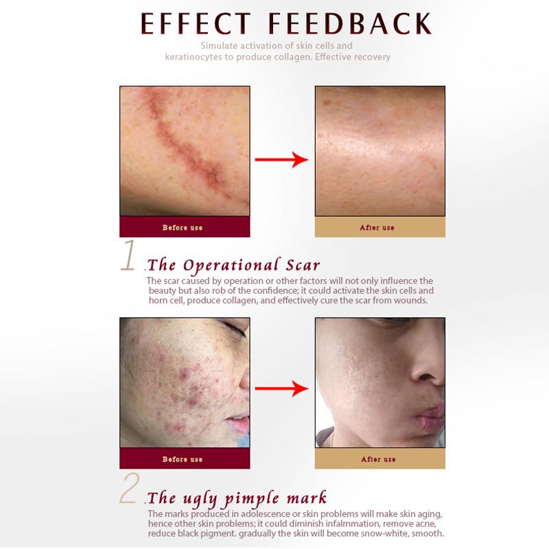 ARTISCARE Гель для удаления шрамов и прыщей 30 г TCM Лечение черных точек Уход за кожей