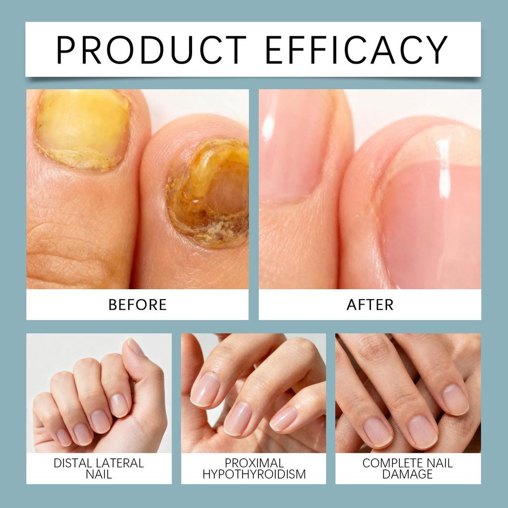 3 Days Nail Care Serum Repair Nail Fungus Paronychia Relieve Cracked Damaged Toenails Strengthener Onychomycosis Removal Serum