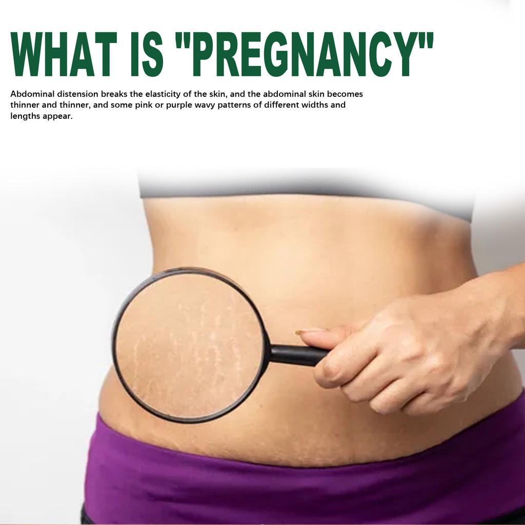 Предотвращение растяжек Предотвращение и исчезновение растяжек Удаление шрамов от растяжек Растяжки для мамочек и матерей