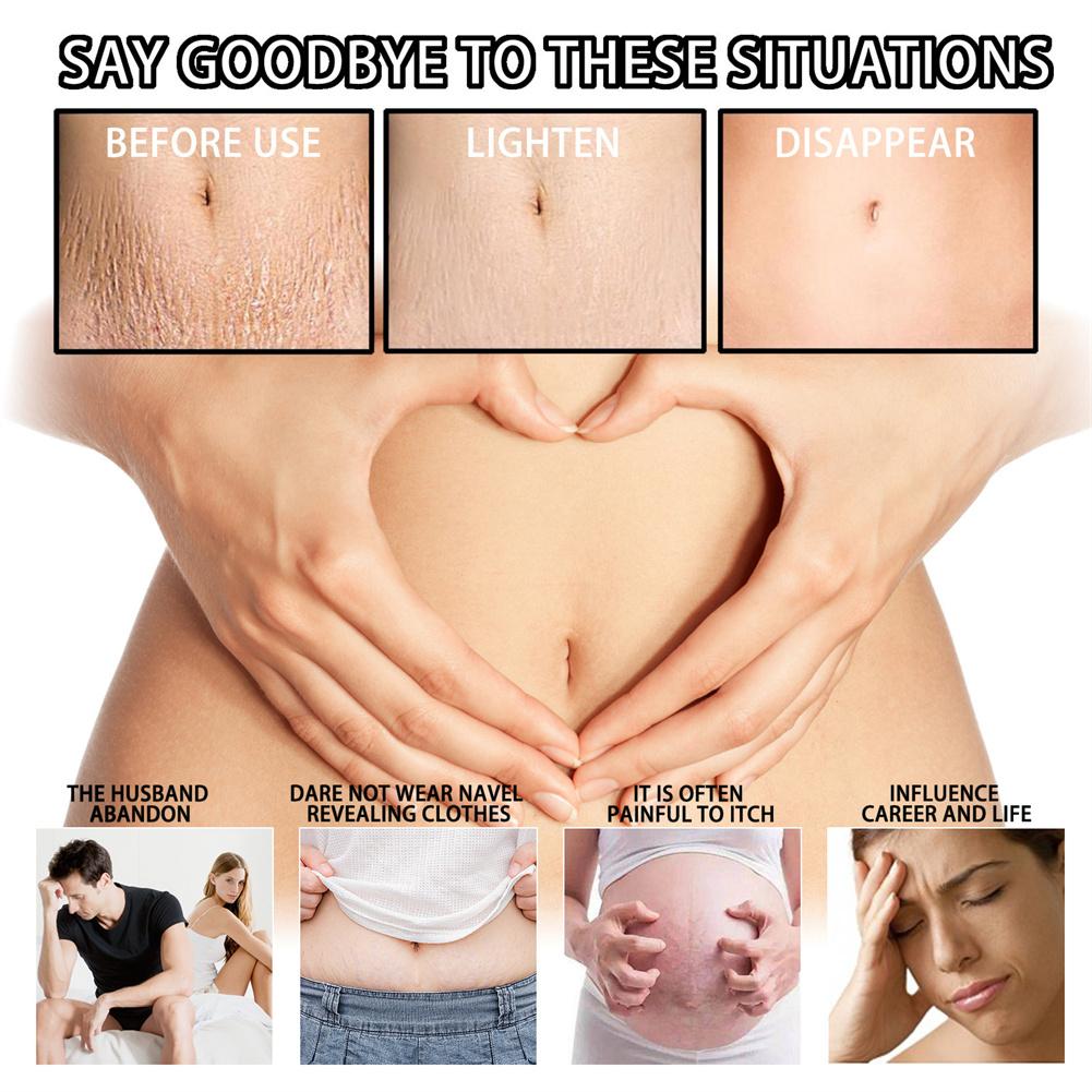 Удалить шрамы от беременности, крем от прыщей, лечение растяжек, восстановление для беременных, антивозрастной крем против морщин, укрепляющий крем для тела