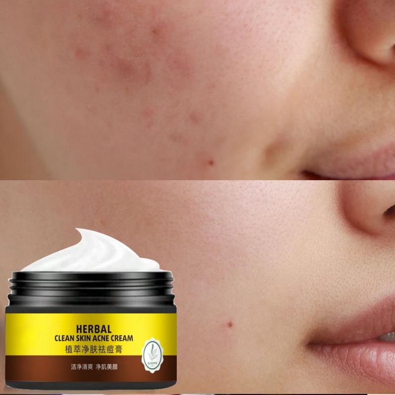 Acne Removing and Acne Removing Acne Repair and Desalination of Acne Print Cream