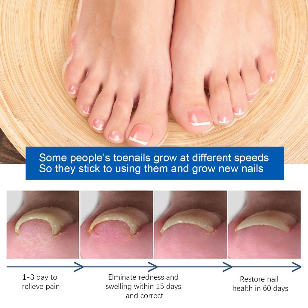 Масло для ногтей от бороздок 30 мл. Масло для ногтей от вросших ногтей, воспаление, поддержание здоровья ногтей, смягчение масла для ногтей от бороздок