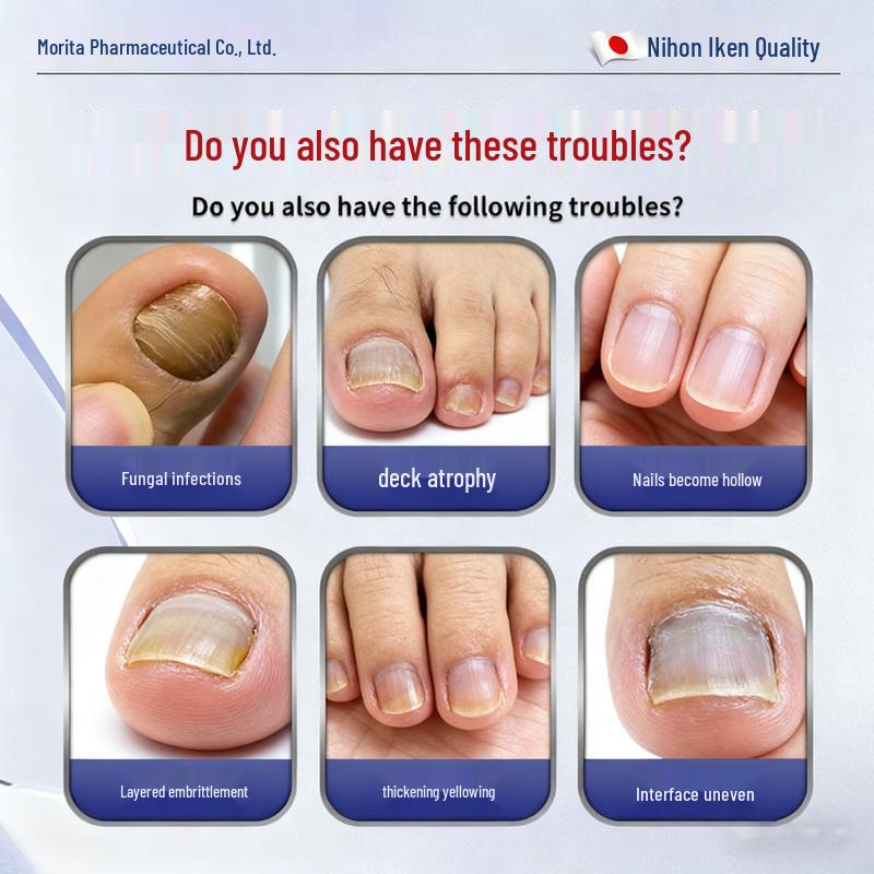 Que Yi Shi Jia Antifungal Nail Repair Solution