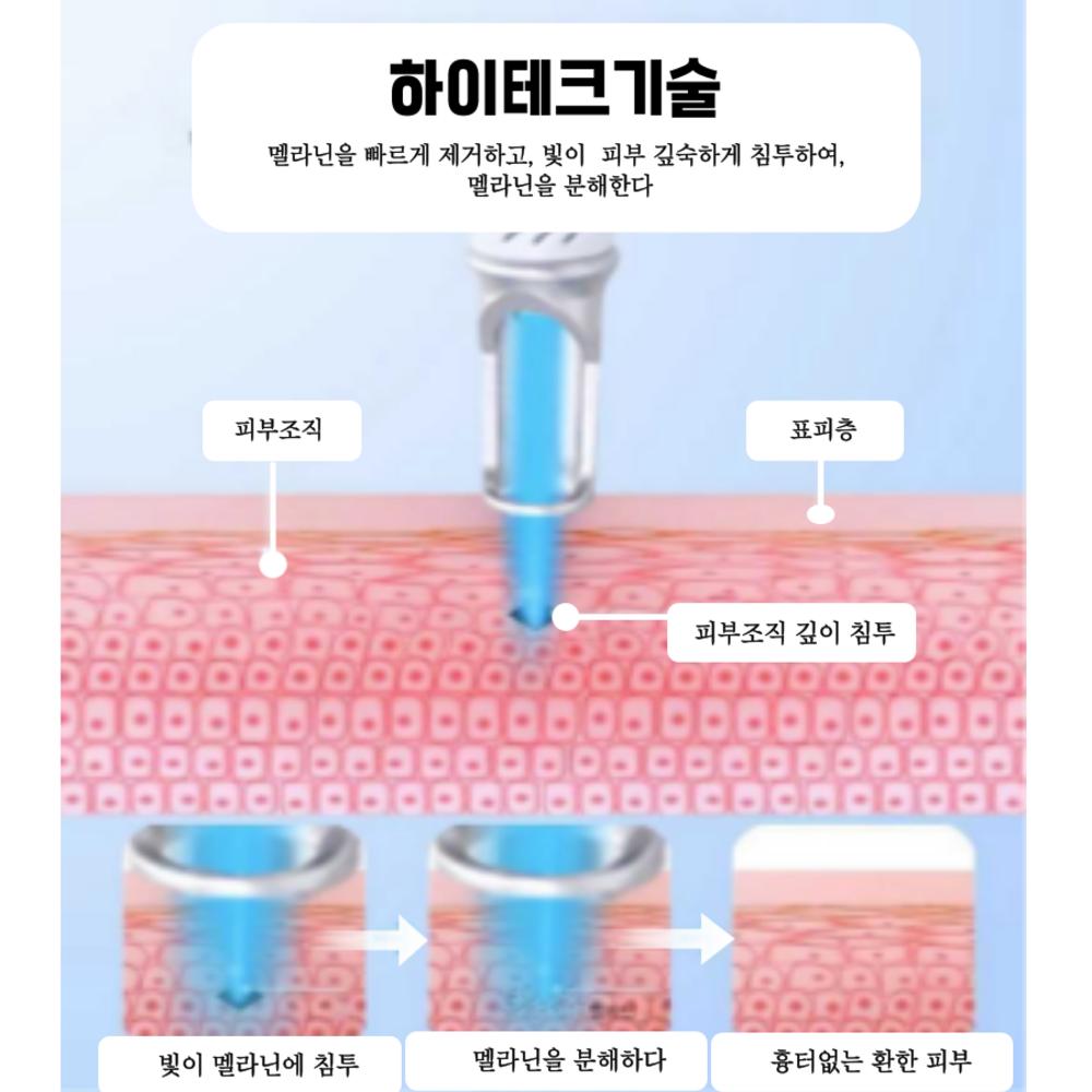 Машина для удаления татуировок MKS, пикосекундный лазерный аппарат для удаления пятен, 1 шт., стандартный тип для удаления пятен